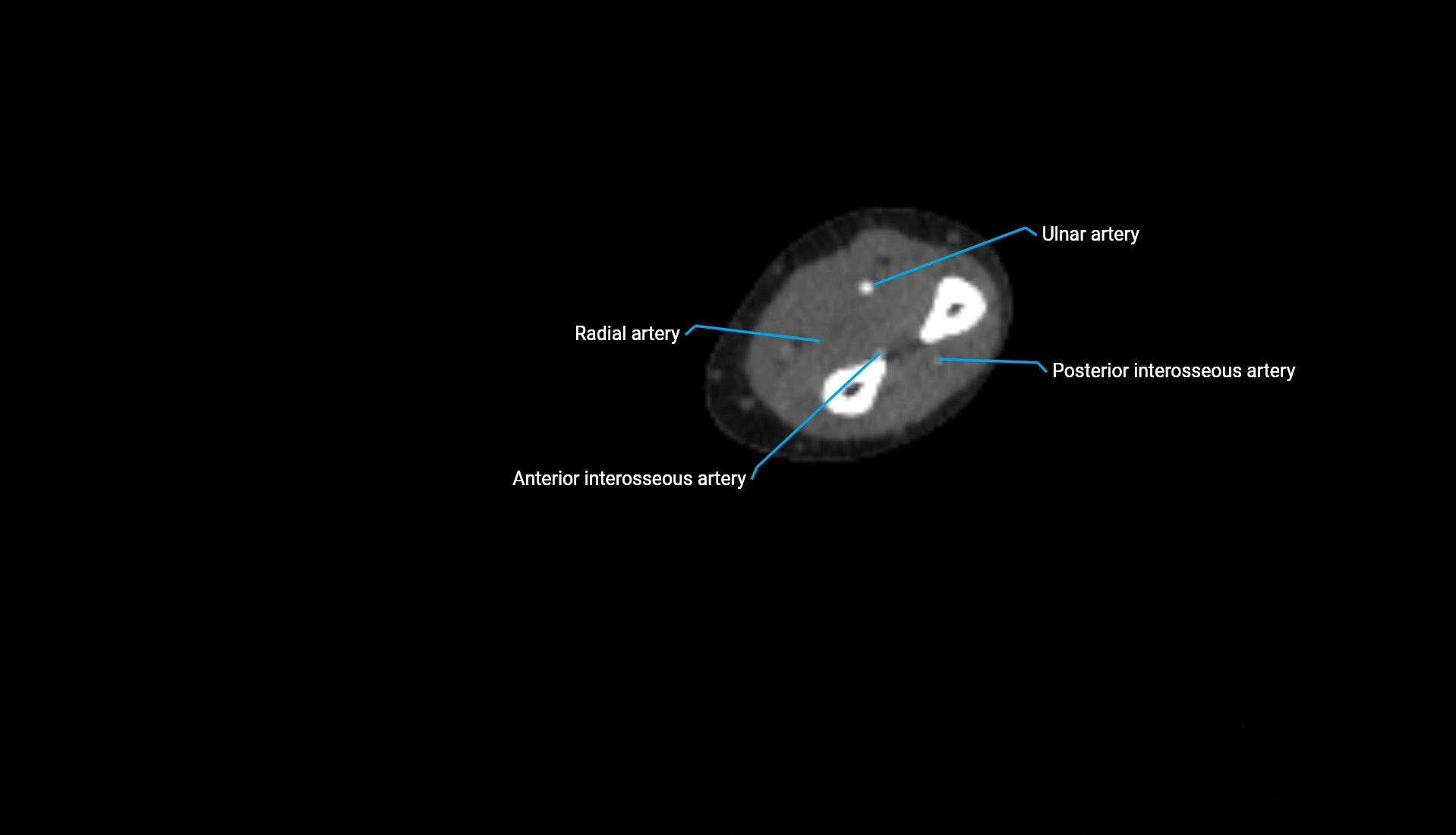 CTA upper limb axial cross sectional anatomy labelled image 145 (2).webp
